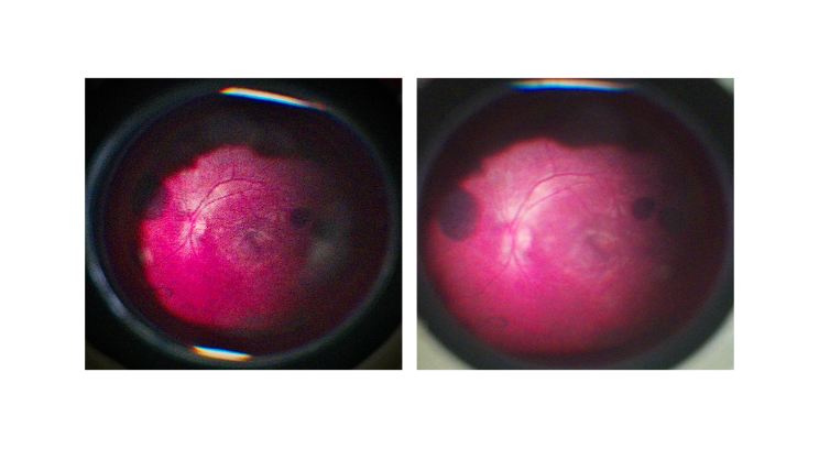 Retinal images captured with the Retinex prototype during early-stage imaging tests.
